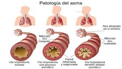 patologia del asma dia mundial fisioterapia respiratoria centro guna salud y bienestar